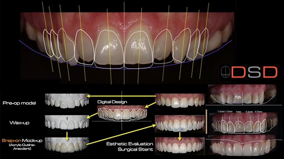 طراحی لبخند در مطب دکتر زهرا ظهری متخصص جراحی لثه و ایمپلنت و لیزر در دندانپزشکی